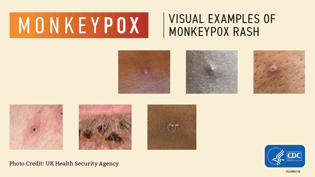 Monkey Pox | Florida Department of Health in Escambia