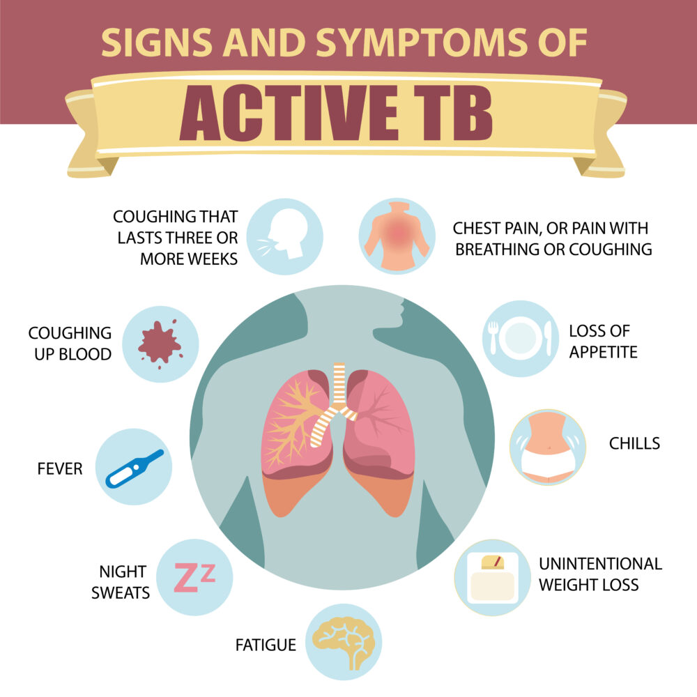 infographic of tb symptoms: coughing, chest pain, coughing up nlood, fever, night sweats, fatigure, weight loss, chills, loss of apetite